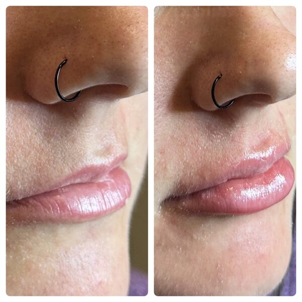 Dermal Fillers