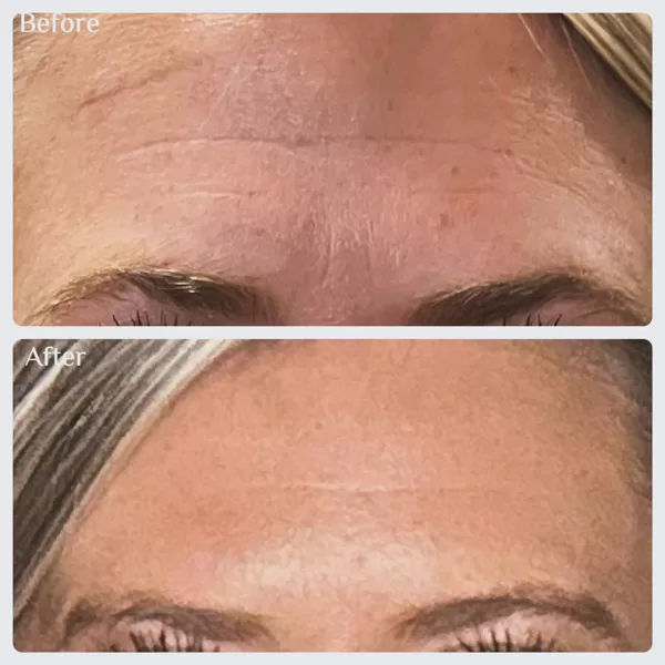 Botox