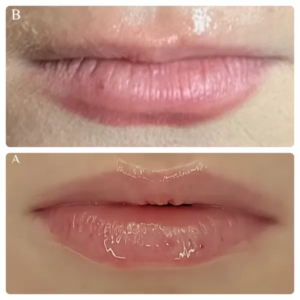 Lip Flip